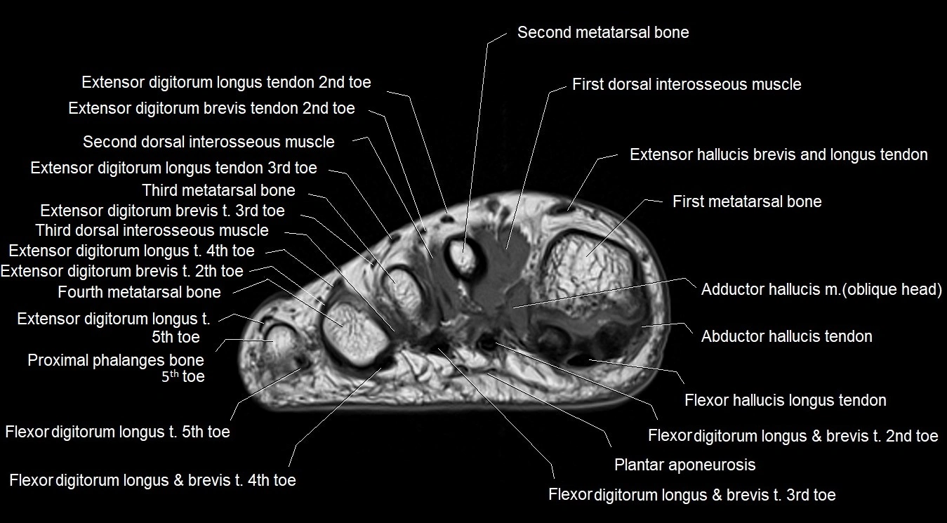 MRI 3T foot axial cross sectional anatomy image 25.webp
